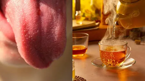 tongue-burnt.1.3946871