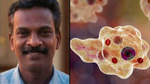 amoebic-meningitis-death-kozhikode