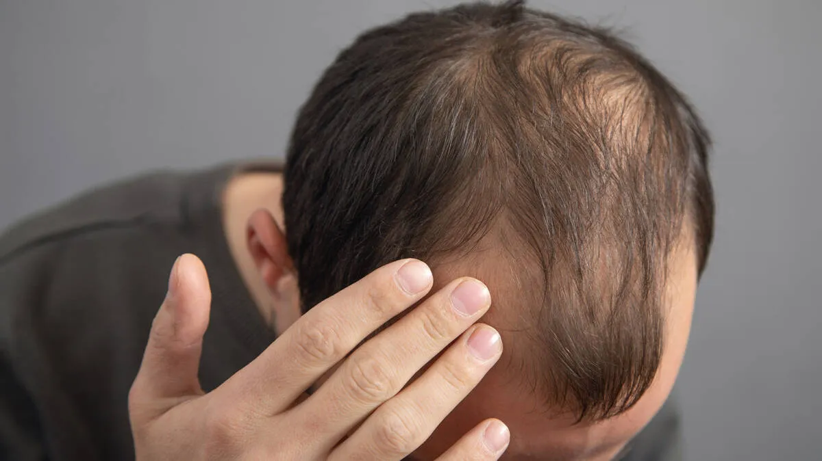 hair-loss